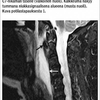 Pitkän kaulalihaksen kalkkiutuva jännetulehdus voi aiheuttaa akuutin kaulakivun