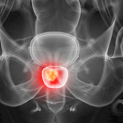 The adverse effects of androgen deprivation therapy in the management of prostate cancer
