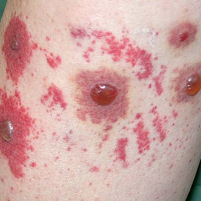 Diverse clinical manifestations, treatment and prognosis of ­cutaneous vasculitis