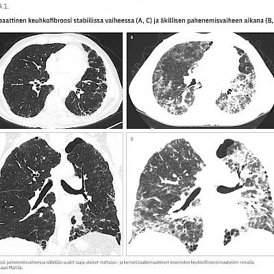 Keuhkofibroosien äkilliset pahenemisvaiheet ovat haastavia diagnosoida ja hoitaa