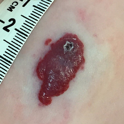 Infantile hemangioma and other vascular anomalies in children