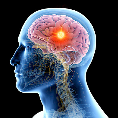 Lievä aivovamma vaikuttaa tunne- ja tiedonkäsittelytoimintoihin