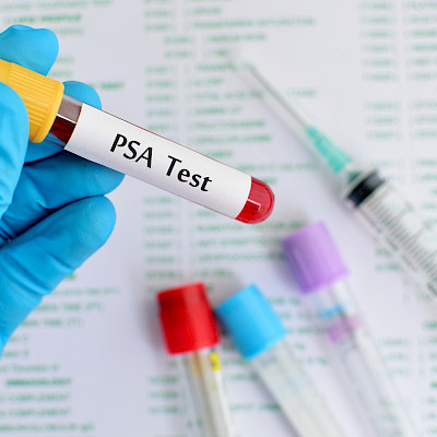 Miten reagoida PSA:n nousuun eturauhassyövän radikaalihoidon jälkeen?