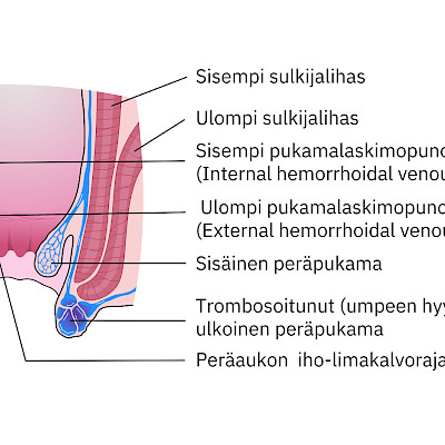 Modern treatment of haemorroids