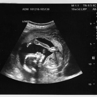 Kätilön tekemä ultraääni tukee perhettä