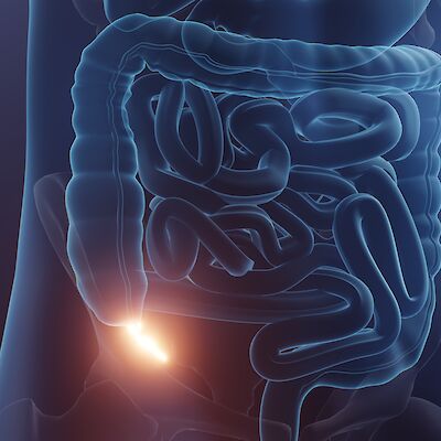 Komplisoitumattoman umpilisäketulehduksen hoito antibiooteilla turvallista