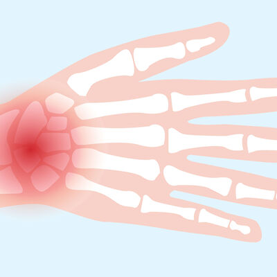 Ranteita leikataan liikaa – usein kipsi riittää