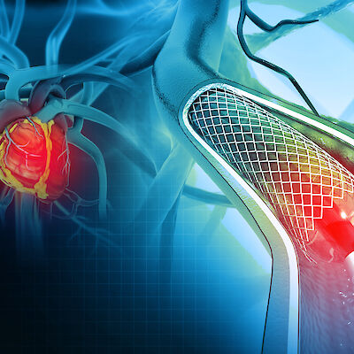 Pallolaajennus kustannustehokas monisuonitaudin hoidossa