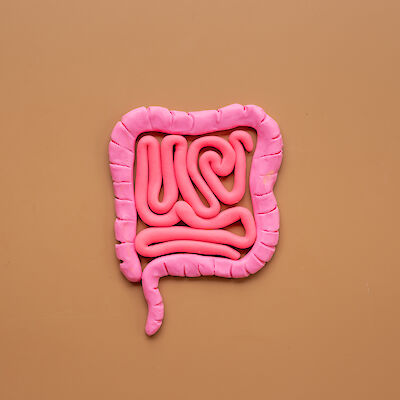 Suolistosyöpä yleistyy – pitäisikö seulontaa laajentaa?