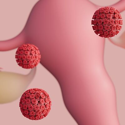 Genotyypitys tehostaisi kohdunkaulan syövän seulontaa
