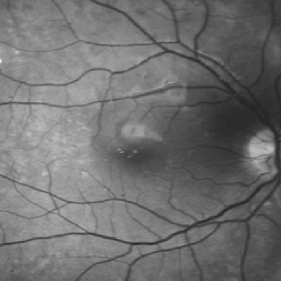 Verisuonten kasvutekijän estäjät diabeettisen retinopatian hoidossa