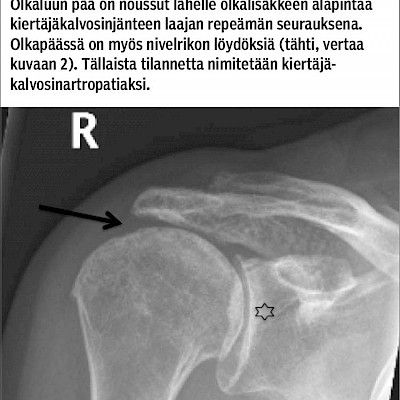 Kivulias olkapää