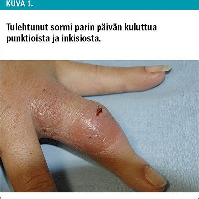 Maahanmuuttajan tulehtunut sormi