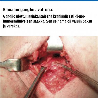 Rare axillary tumour