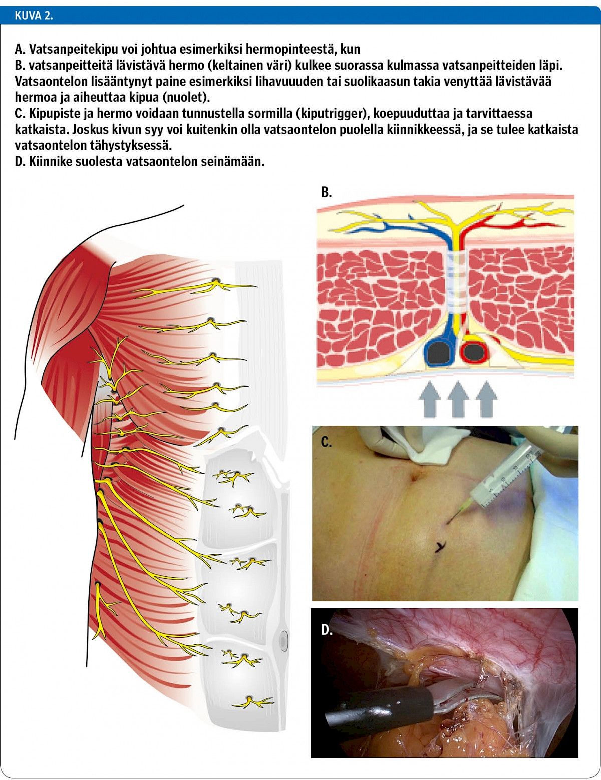 A. Vatsanpeitekipu voi johtua esimerkiksi hermopinteestä, kun B. vatsanpeitteitä lävistävä hermo (keltainen väri) kulkee suorassa kulmassa vatsanpeitteiden läpi. Vatsaontelon lisääntynyt paine esimerkiksi lihavuuuden tai suolikaasun takia venyttää lävistävää hermoa ja aiheuttaa kipua (nuolet). C. Kipupiste ja hermo voidaan tunnustella sormilla (kiputrigger), koepuuduttaa ja tarvittaessa katkaista. Joskus kivun syy voi kuitenkin olla vatsaontelon puolella kiinnikkeessä, ja se tulee katkaista vatsaontelon tähystyksessä. D. Kiinnike suolesta vatsaontelon seinämään.<p/>