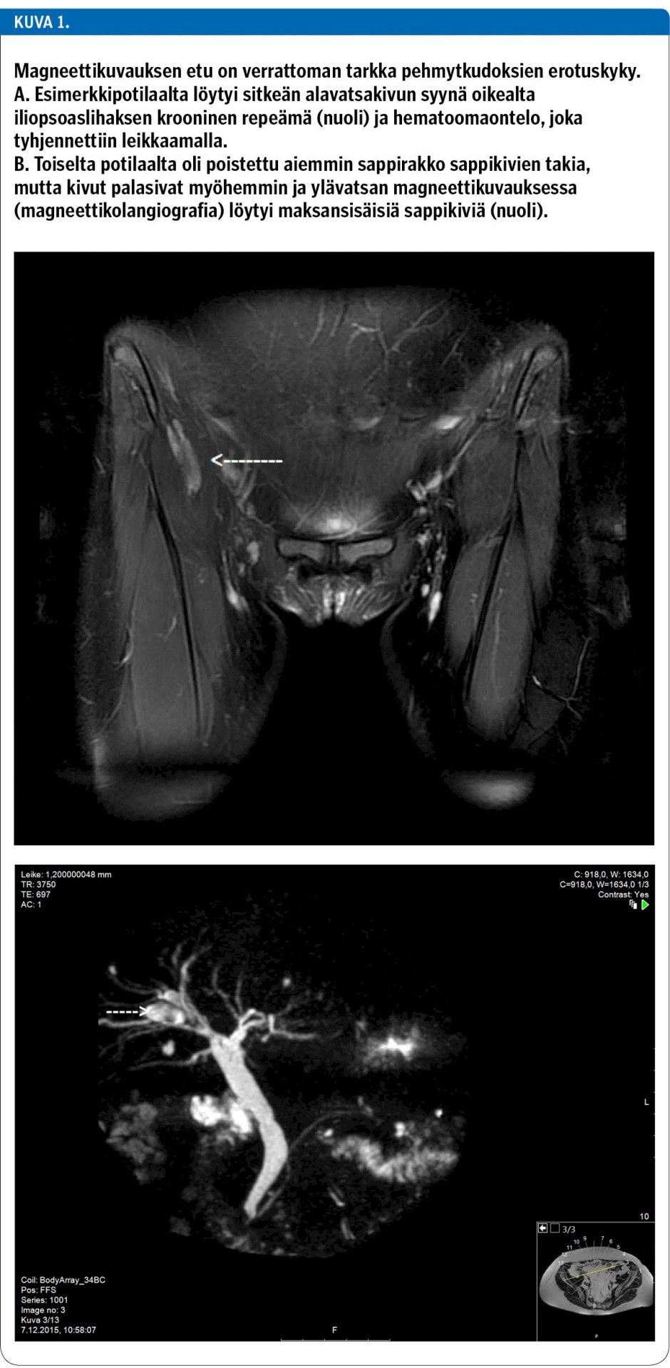 Magneettikuvauksen etu on verrattoman tarkka pehmytkudoksien erotuskyky. A. Esimerkkipotilaalta löytyi sitkeän alavatsakivun syynä oikealta iliopsoaslihaksen krooninen repeämä (nuoli) ja hematoomaontelo, joka tyhjennettiin leikkaamalla. B. Toiselta potilaalta oli poistettu aiemmin sappirakko sappikivien takia, mutta kivut palasivat myöhemmin ja ylävatsan magneettikuvauksessa (magneettikolangiografia) löytyi maksansisäisiä sappikiviä (nuoli).<p/>