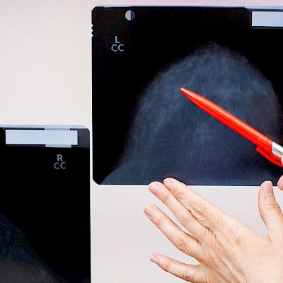 Iäkkäälle naiselle räätälöity mammografiaseuranta