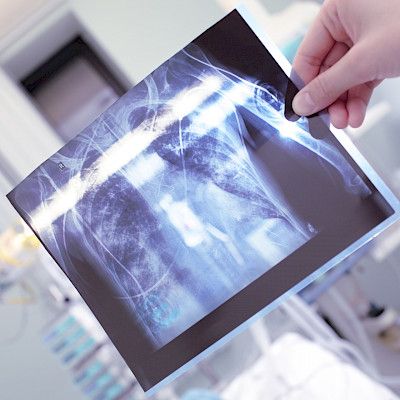 Lääkkeille vastustuskykyisten tuberkuloositapausten määrä kasvoi