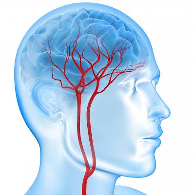 SAV:n jälkeen tulee usein epilepsia tai masennus