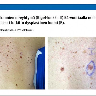 Melanooman riskitekijät