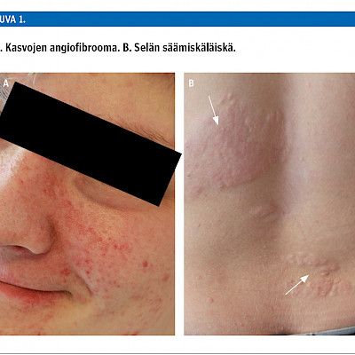 Tuberoosiskleroosi – suomalainen diagnoosi- ja seurantasuositus