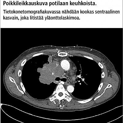 Kasvoja turvottava yskä