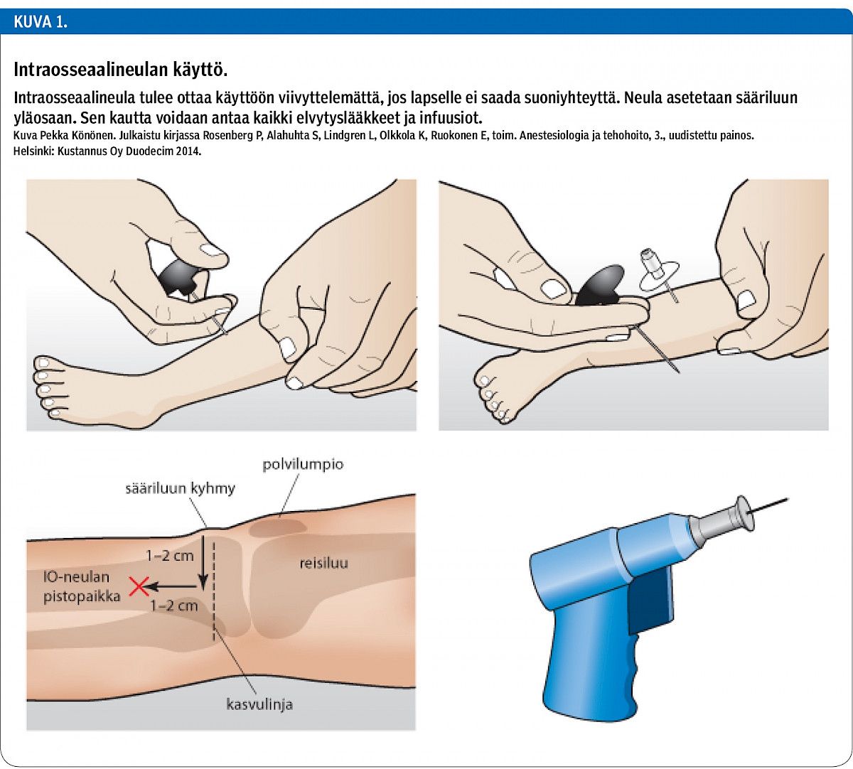Intraosseaalineulan käyttö.