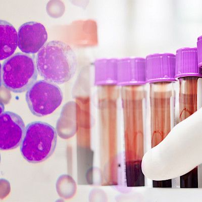Akuuttiin leukemiaan löytyi uusia yksilöllisiä hoitomuotoja