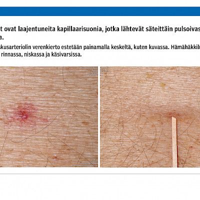 Maksakirroosi – tunnista yleistyvä kansantautimme varhain