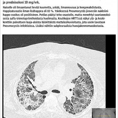 Interstitiaaliset keuhkosairaudetInterstitiaaliset keuhkomuutokset sidekudossairauksissa – perussairaus, lääkehaitta vai infektio?