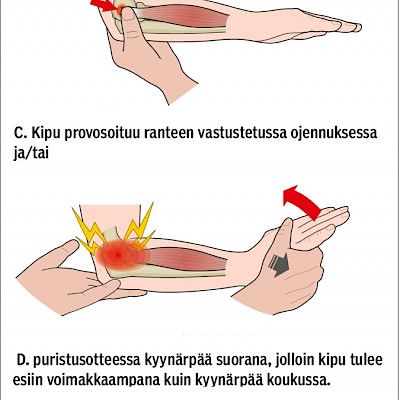 Tenniskyynärpää – hoitamatta paras?