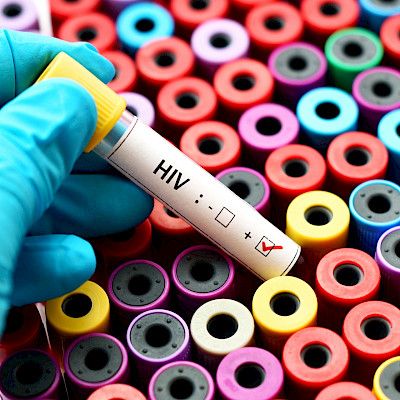 Yli 50-vuotiailla HIV todetaan myöhään