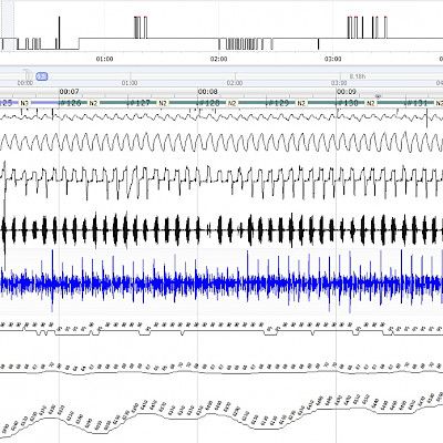 Uniapnea lisää epilepsiapotilaan kohtausriskiä