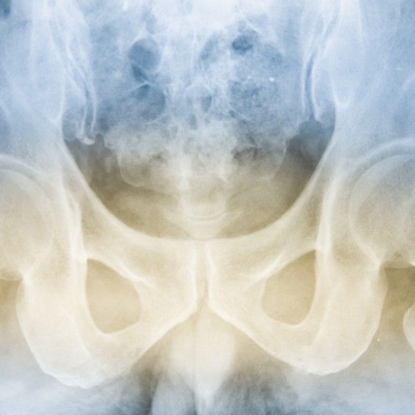 Murtumapotilaiden osteoporoosi jää usein huomiotta