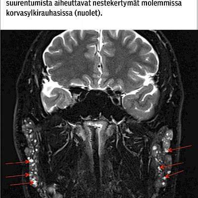 Sjögrenin oireyhtymän kliininen kuva, diagnostiikka ja hoito