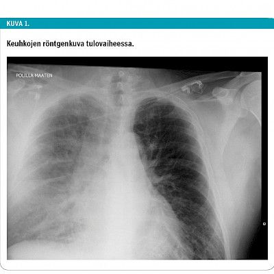 Äkillinen hengenahdistus  iski kotisohvalla