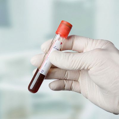 Verikoe voi kertoa muistisairauden riskistä entistä tarkemmin