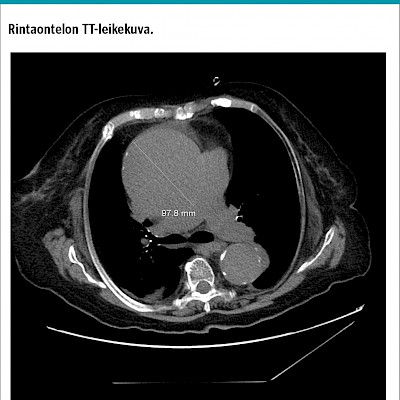 Vastaus: Vanhuksen thoraxlöydös