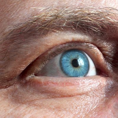 Timololi-silmätipat lisäävät kaatumisriskiä