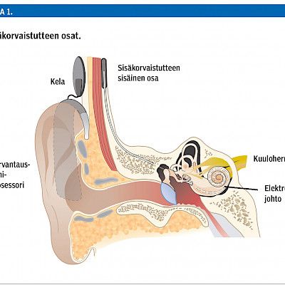 Sisäkorvaistute – kokeellisesta hoidosta arkipäivän kuntoutukseksi