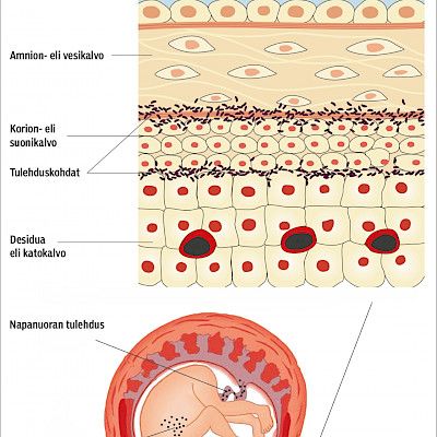 Korioamnioniitin diagnostiikan uudet mahdollisuudet