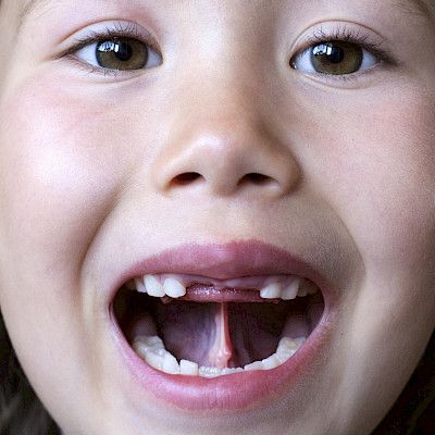 Jäävätkö kielenkehityksen häiriöt diagnosoimatta?