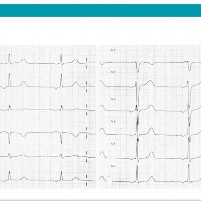 Mieleinen poikakaveri ja EKG-muutos