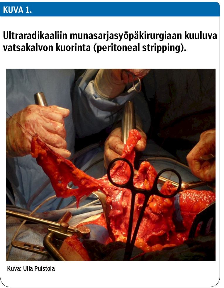 Ultraradikaaliin munasarjasyöpäkirurgiaan kuuluva vatsakalvon kuorinta (peritoneal stripping).<p/>