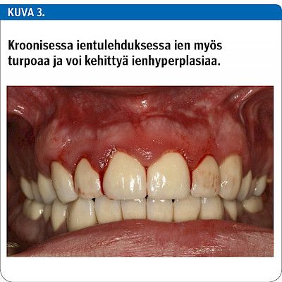 Mitä lääkärin tulee tietää parodontiitista?