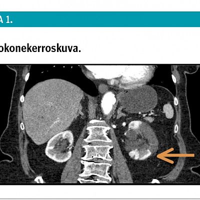 Kova vatsakipu aterian jälkeen