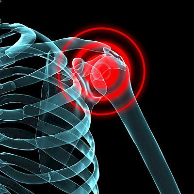 Uutta tietoa WNT1-osteoporoosista