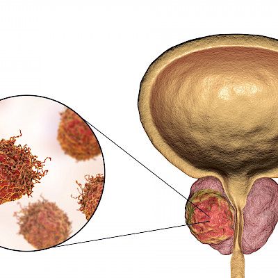 Atorvastatiinin tehosta eturauhassyöpää vastaan jälleen uutta näyttöä