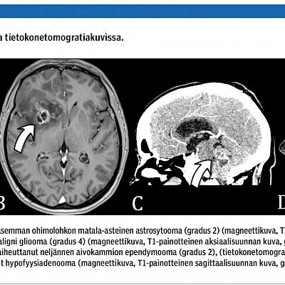 Aikuispotilaan aivokasvaimen toteaminen päivystyksessä