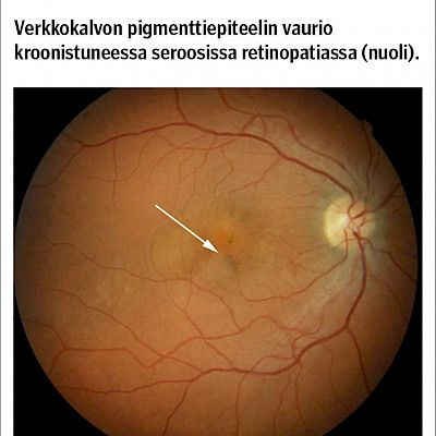 Seroosi retinopatia, nesteinen keskeisen verkkokalvon sairaus